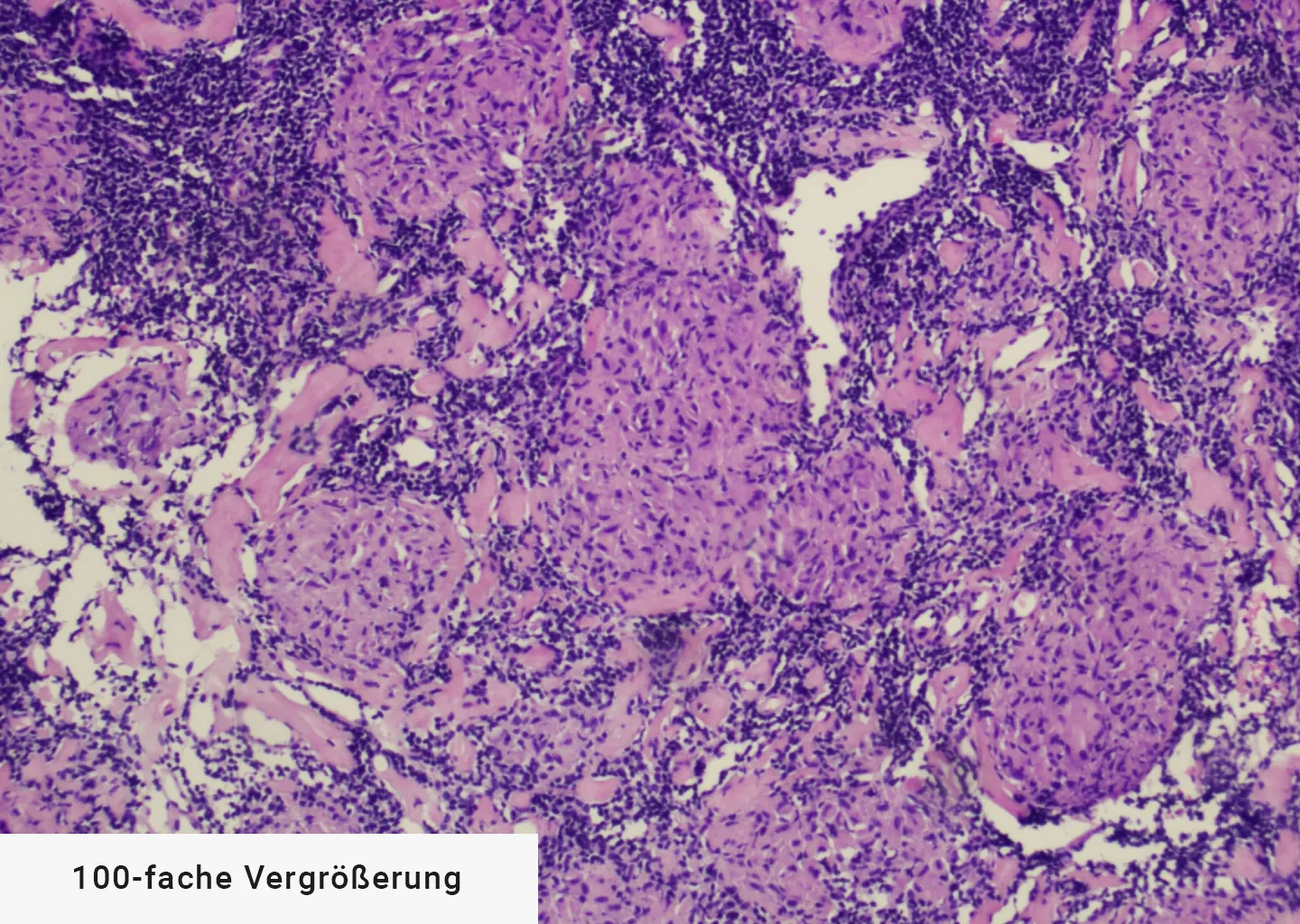 Vergrößerung Sarkoidose