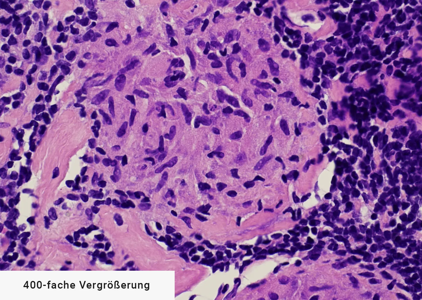 Vergrößerung Sarkoidose