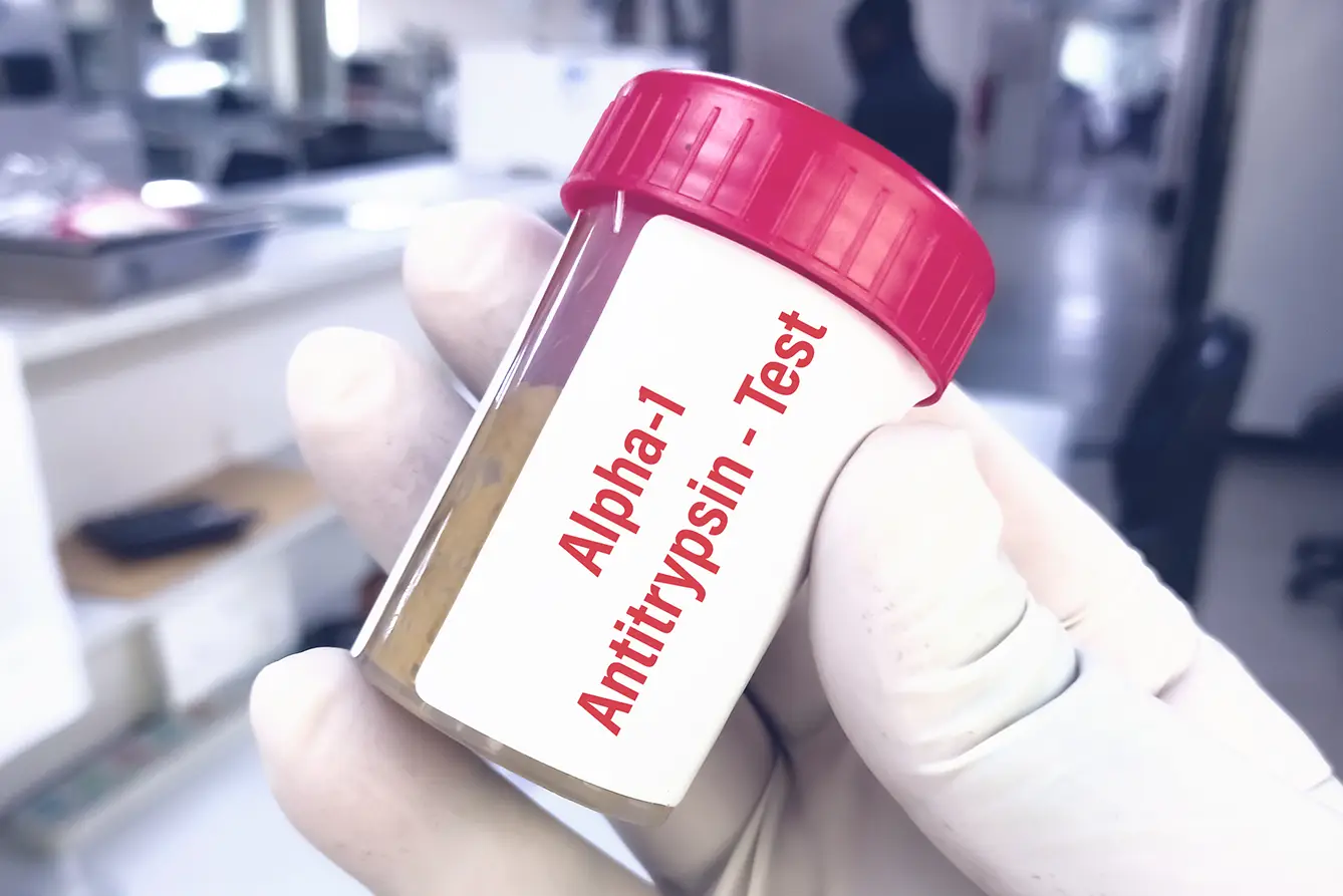 Medizinische Probe mit Aufschrift "Alpha-1-Antitrypsin Test"